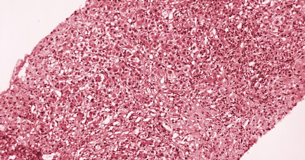 Hepatitis A outbreak declared in L.A. County. What you need to know