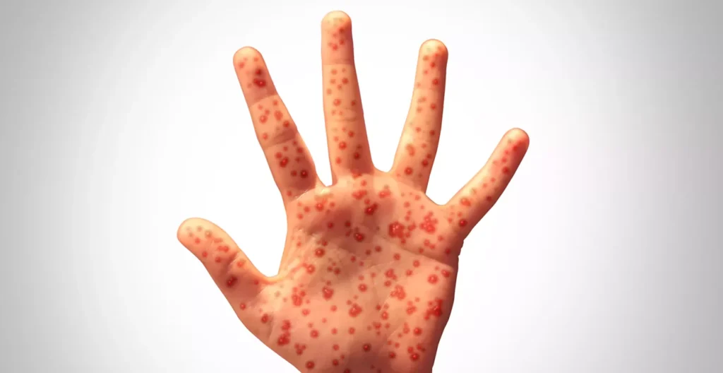 What to know about Arizona measles outbreak in Navajo County