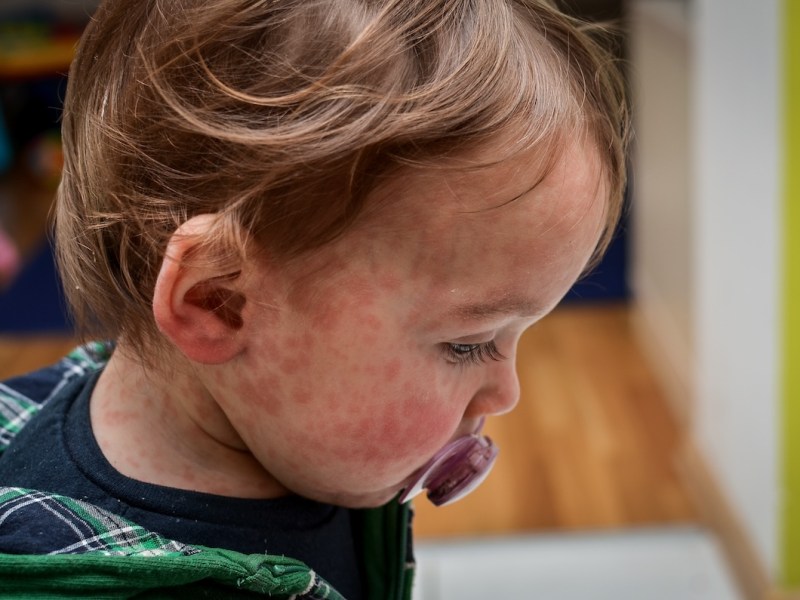 Florida health officials report another seven measles cases