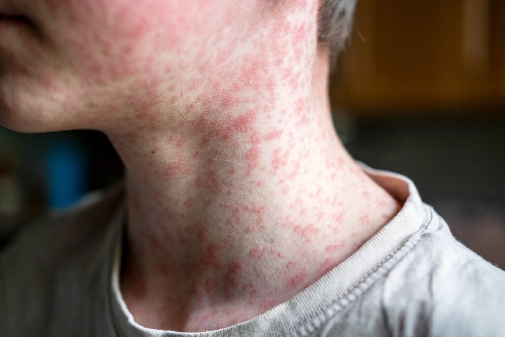 Summer’s coming, and data show Florida measles cases are rising