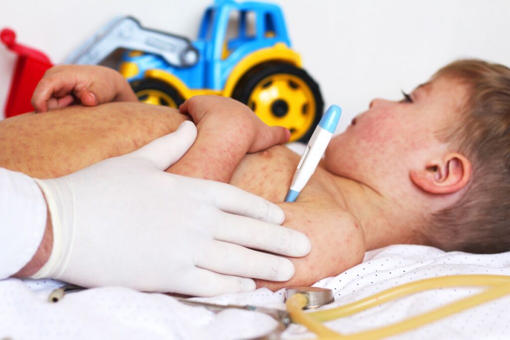 Measles cases have reached a 35-year high